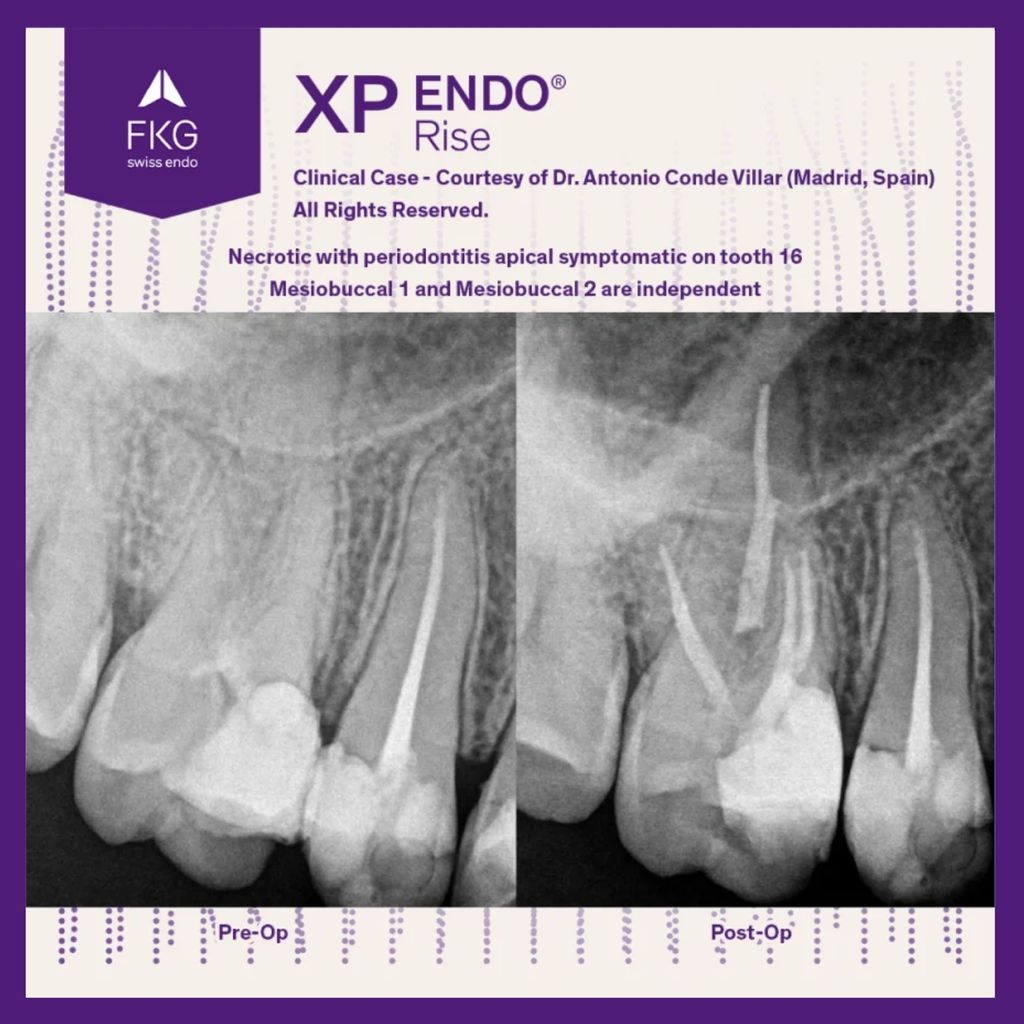 FKG XP-Endo Rise 5
