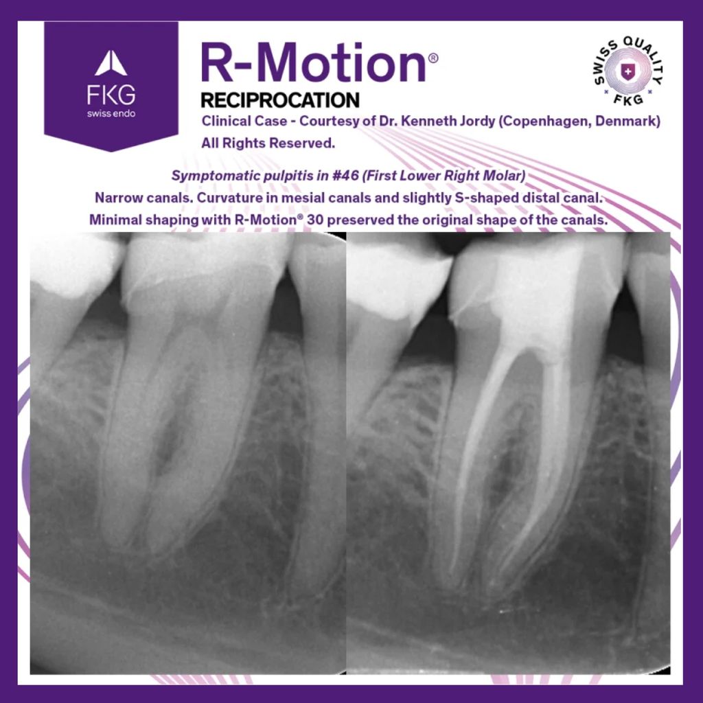 FKG R-Motion Shaper 9