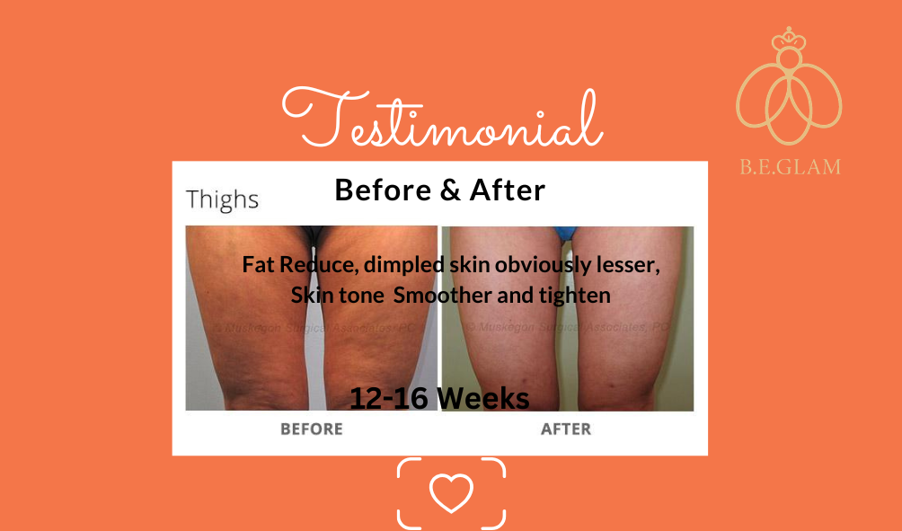 Glam - Anti Cellulite (Before & After) (2)
