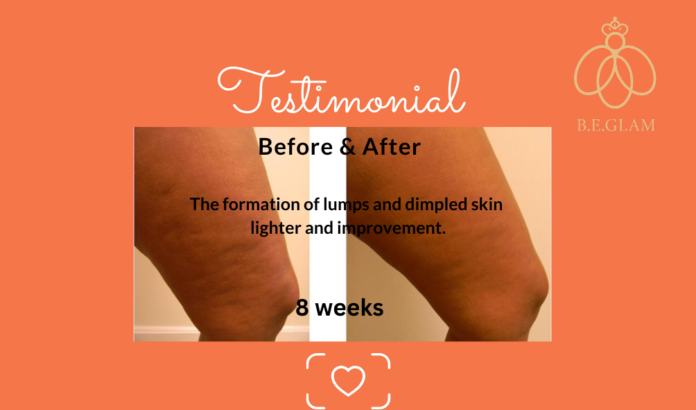 Glam - Anti Cellulite (Before & After) (1)