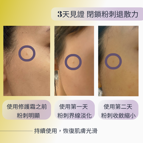Ovegan_Antiacne 2
