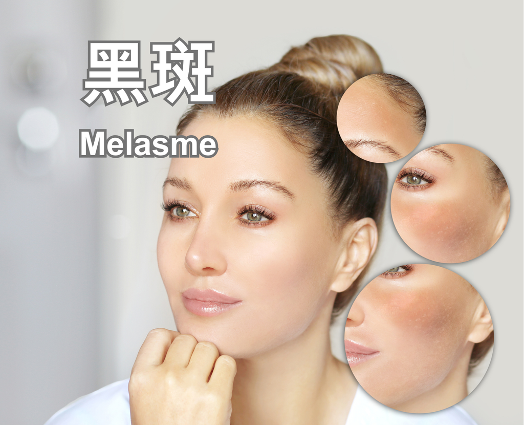 Melasme