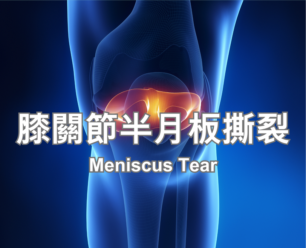 Meniscus Tear