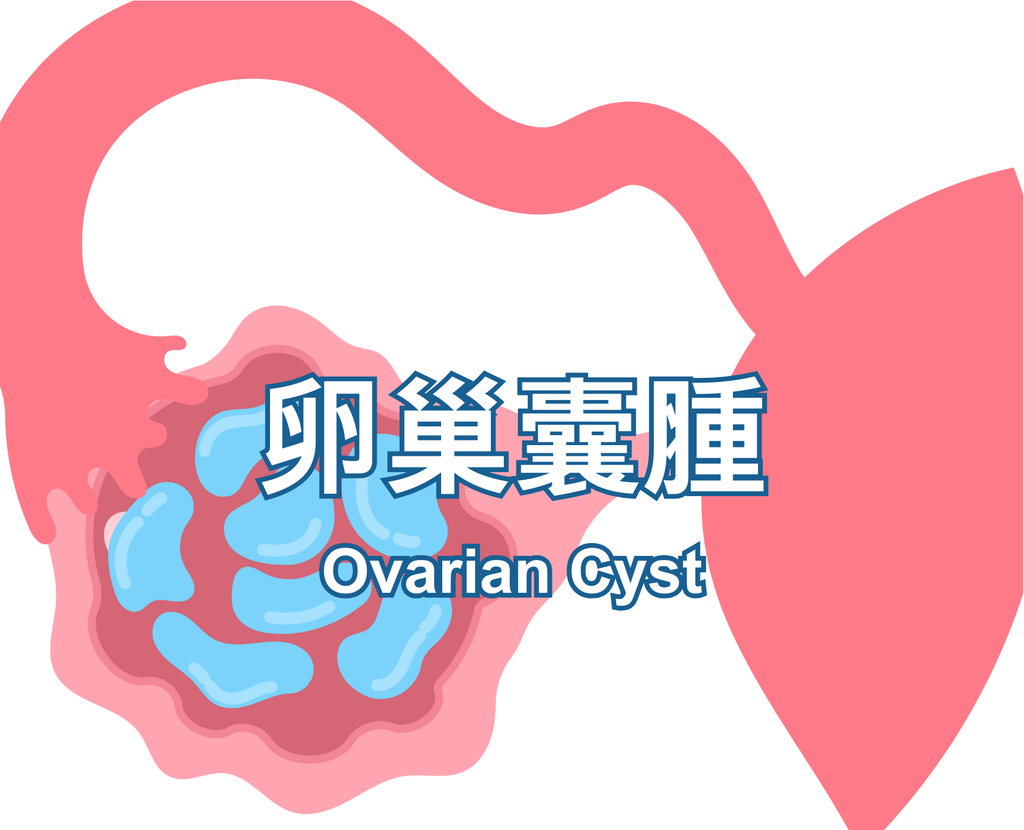Ovarian Cyst
