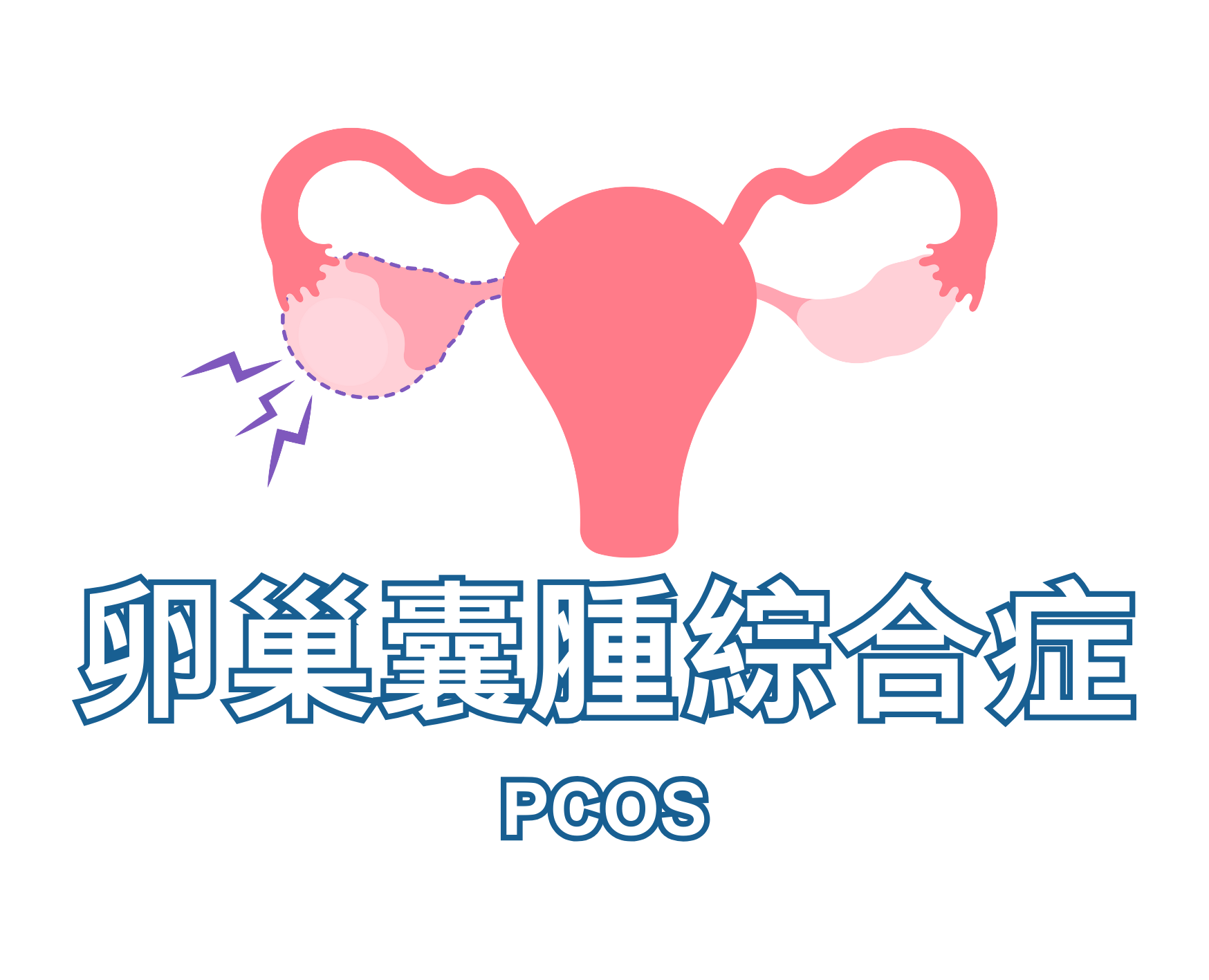 PCOS