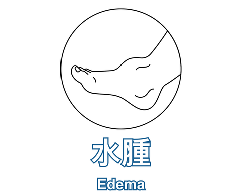 Edema