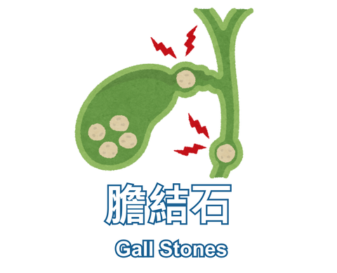 Gall Stones 膽結石