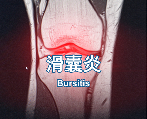 Bursitis