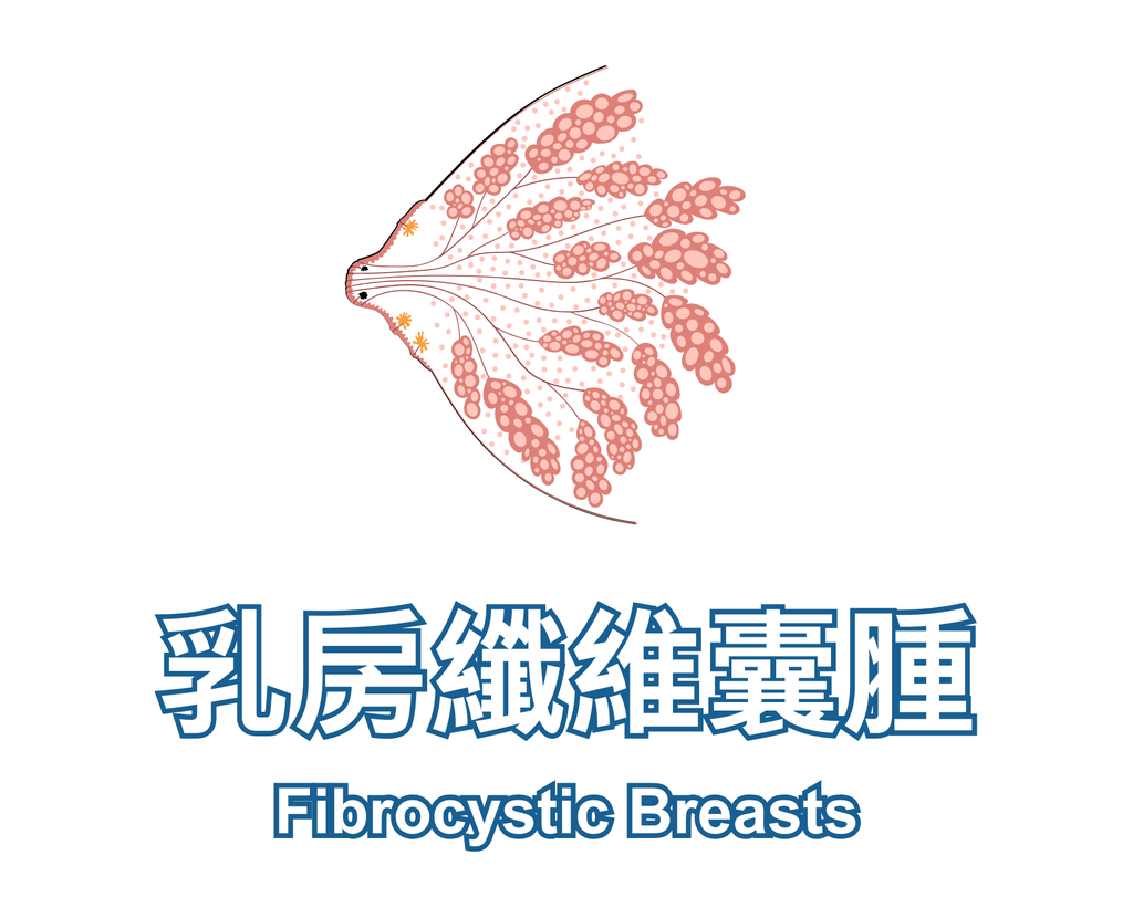 Fibrocystic Breasts 乳房纖維囊腫