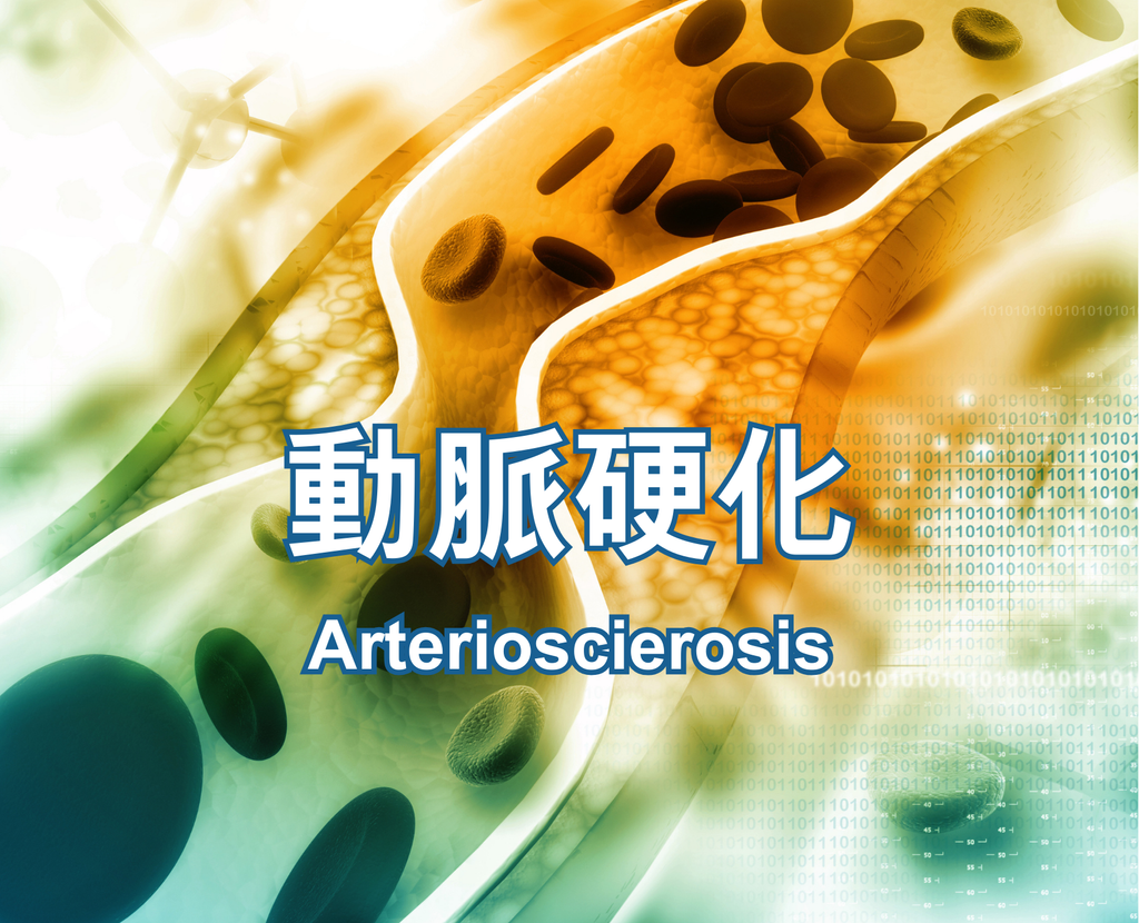 Arterioscierosis