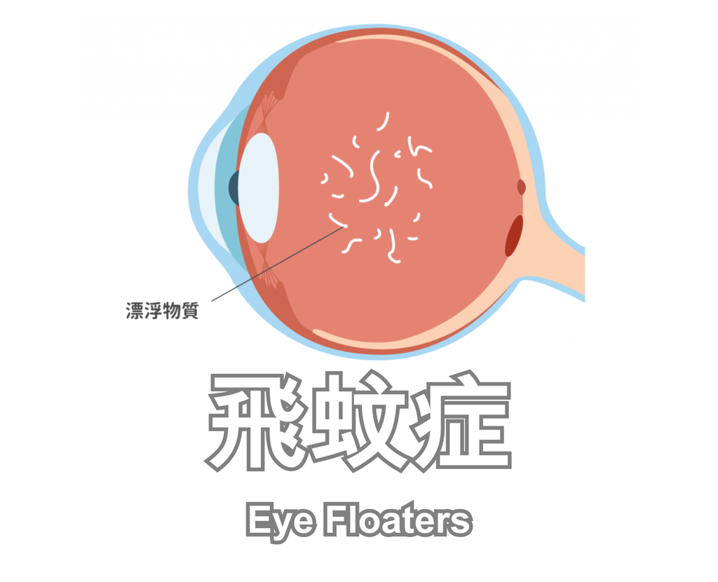 Eye Floaters