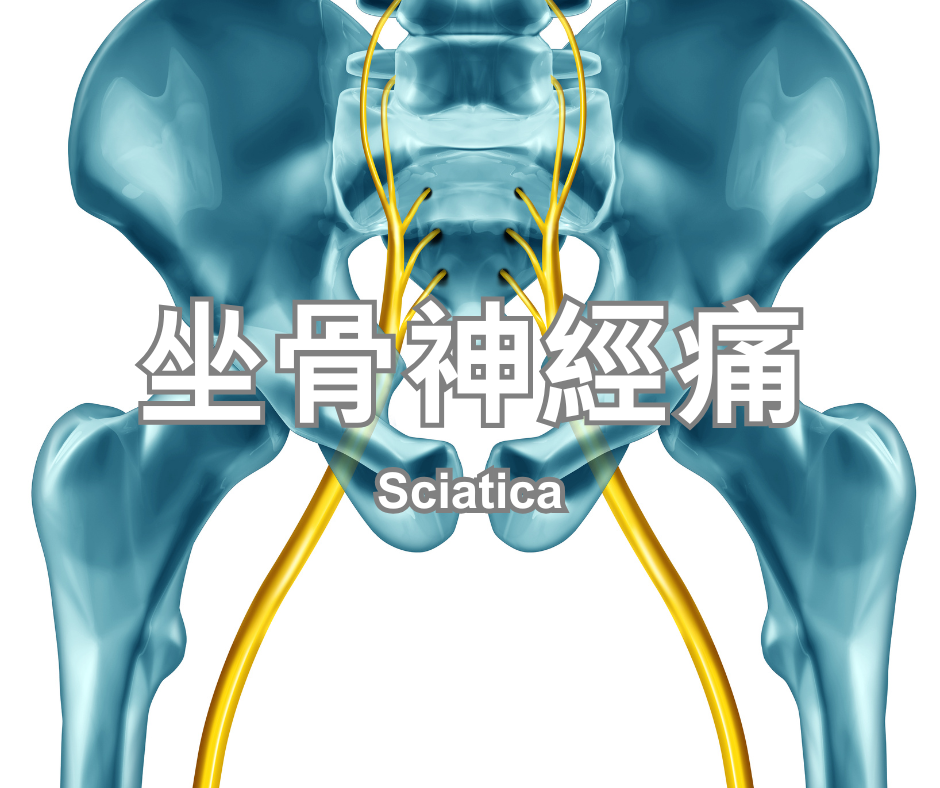 Sciatica