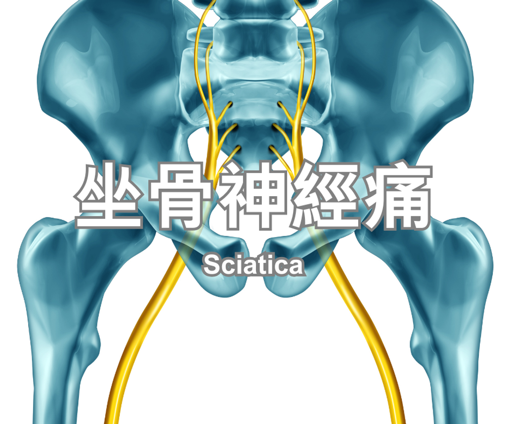 Sciatica