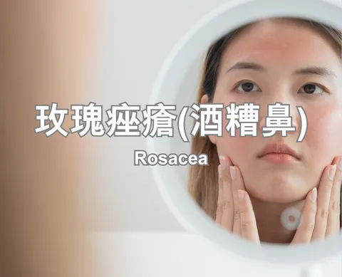 Rosacea