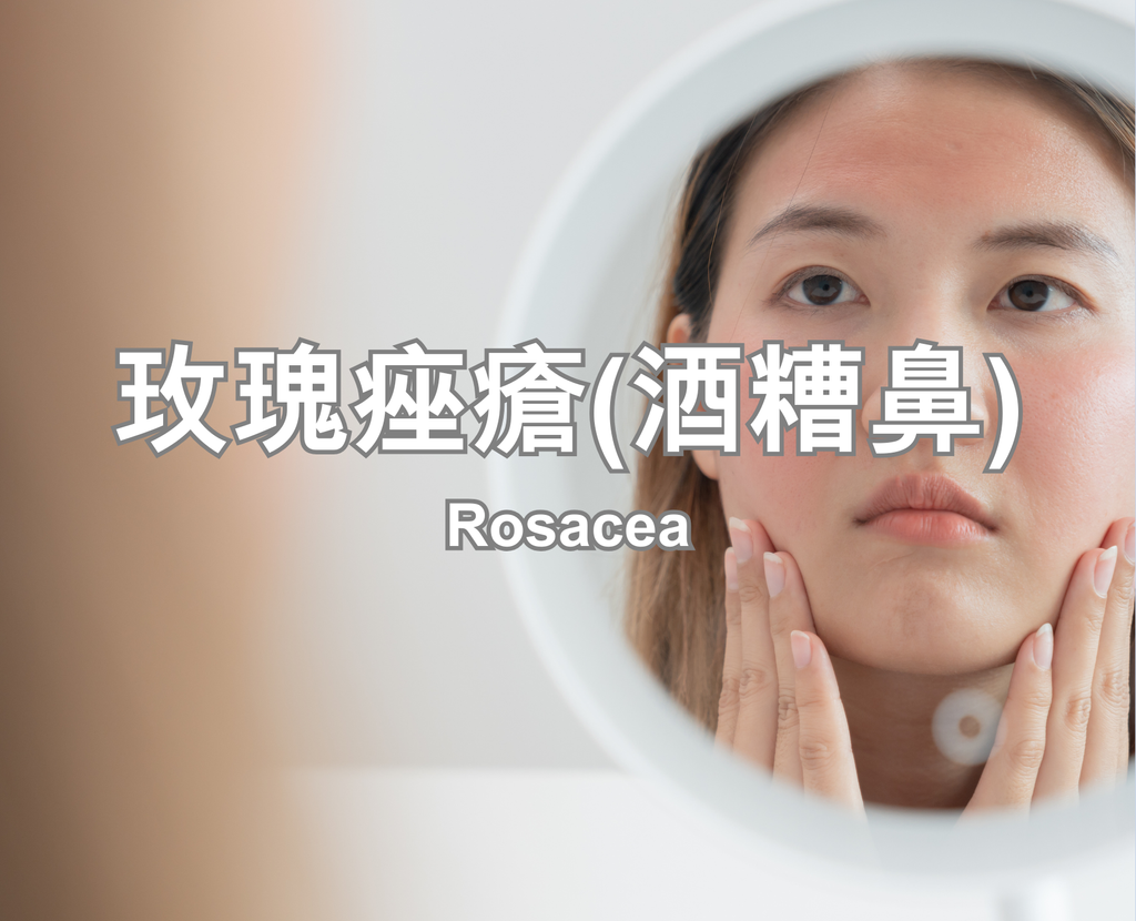 Rosacea