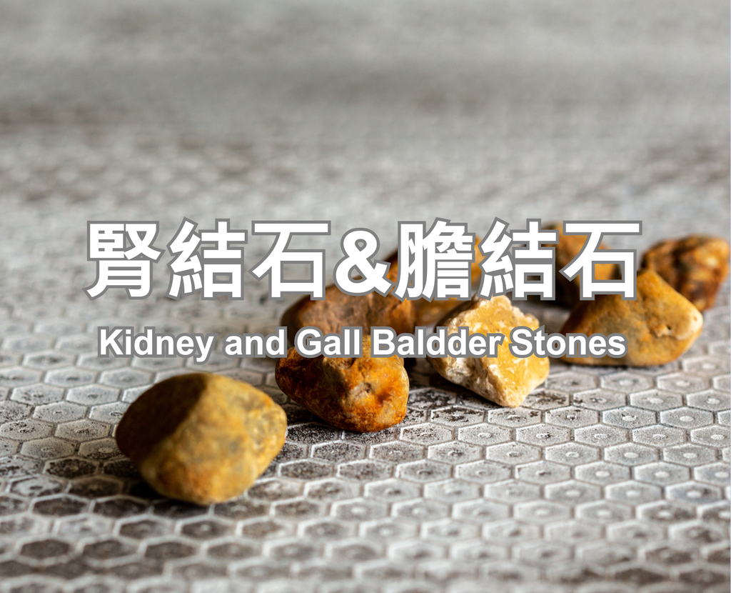 Kidney and Gall Baldder Stones