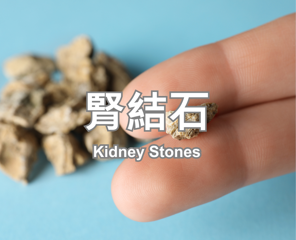 Kidney Stones KD