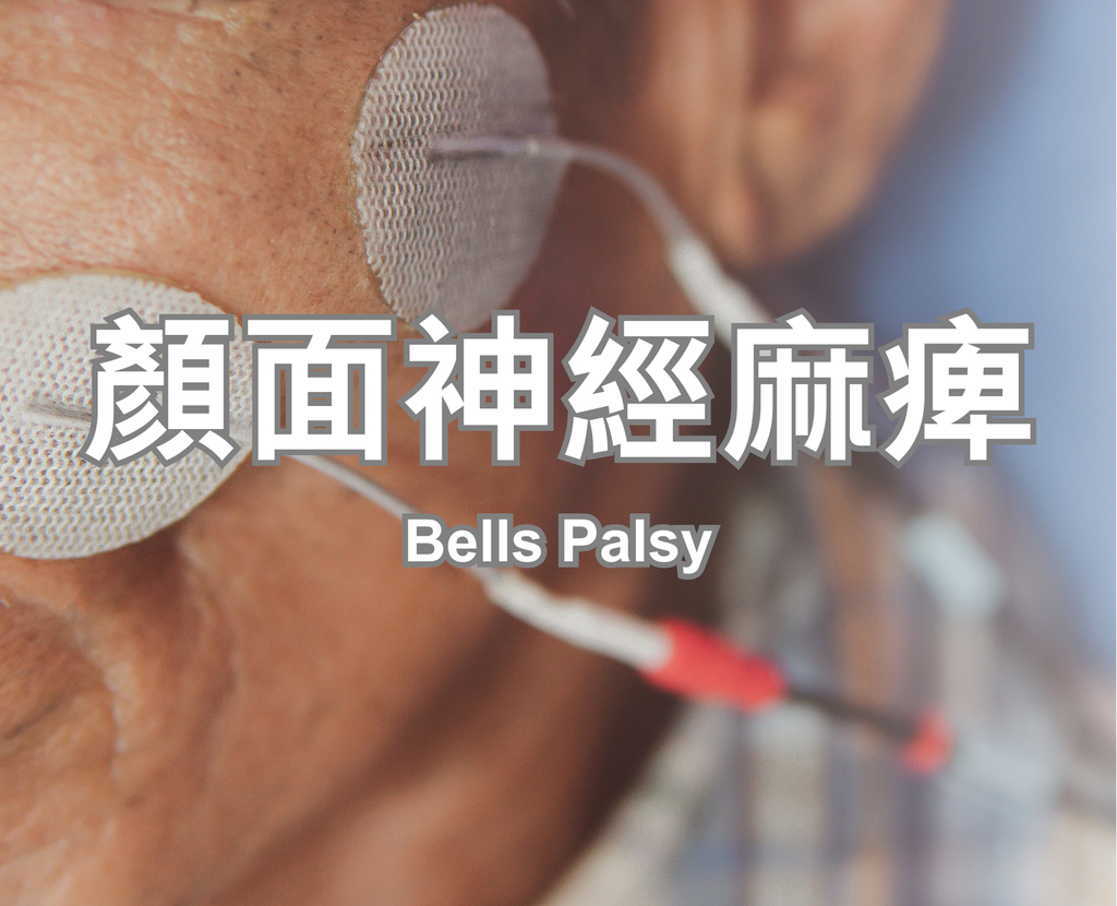 Bells Palsy