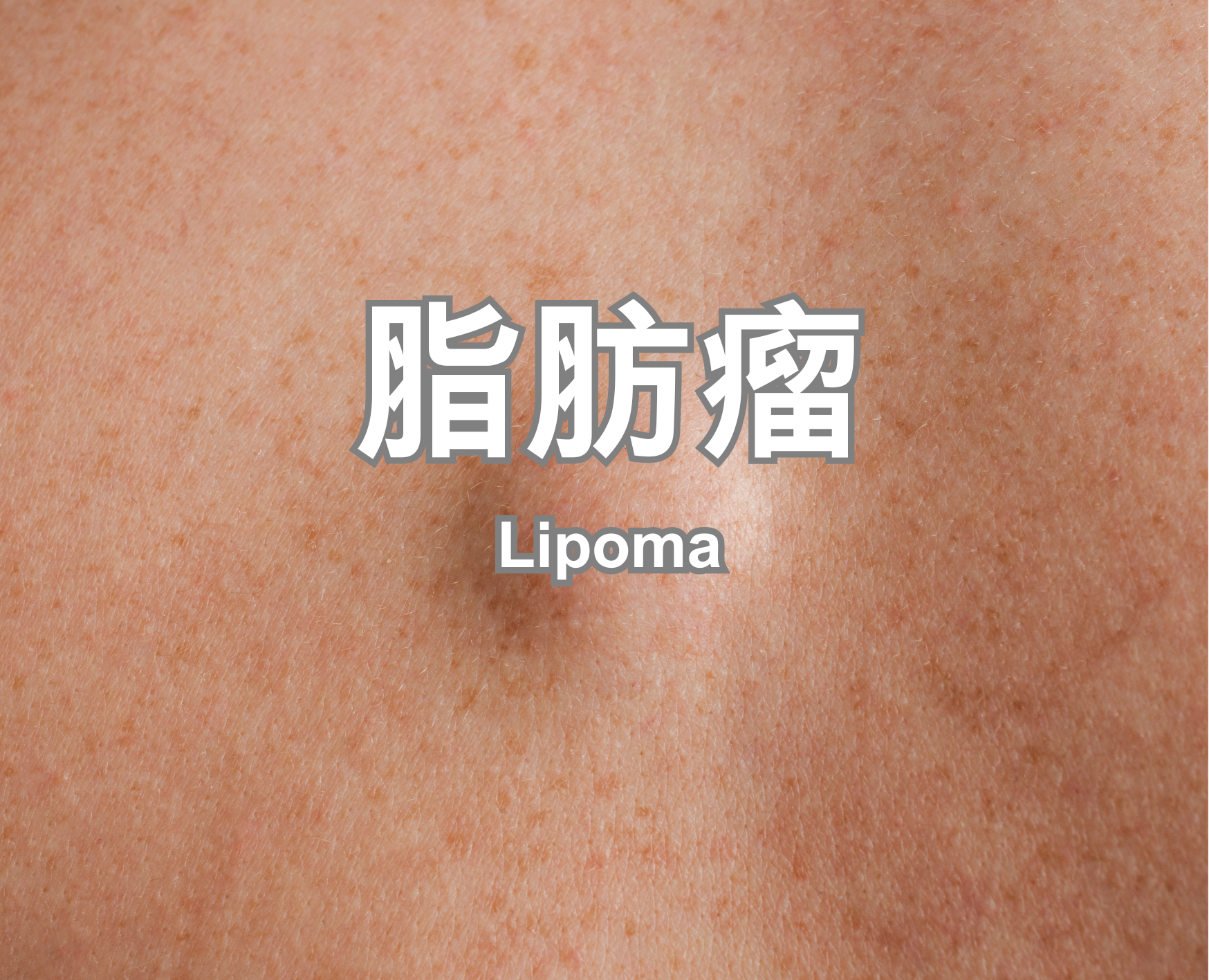 Lipoma