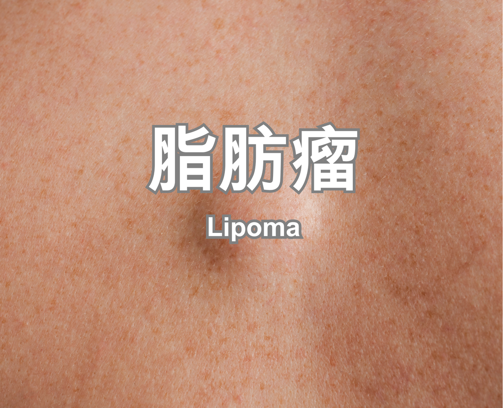 Lipoma