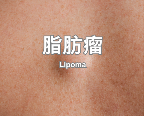 Lipoma