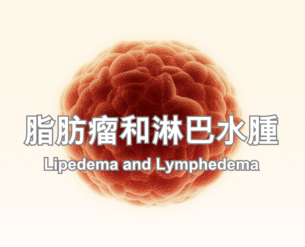 Lipedema and Lymphedema