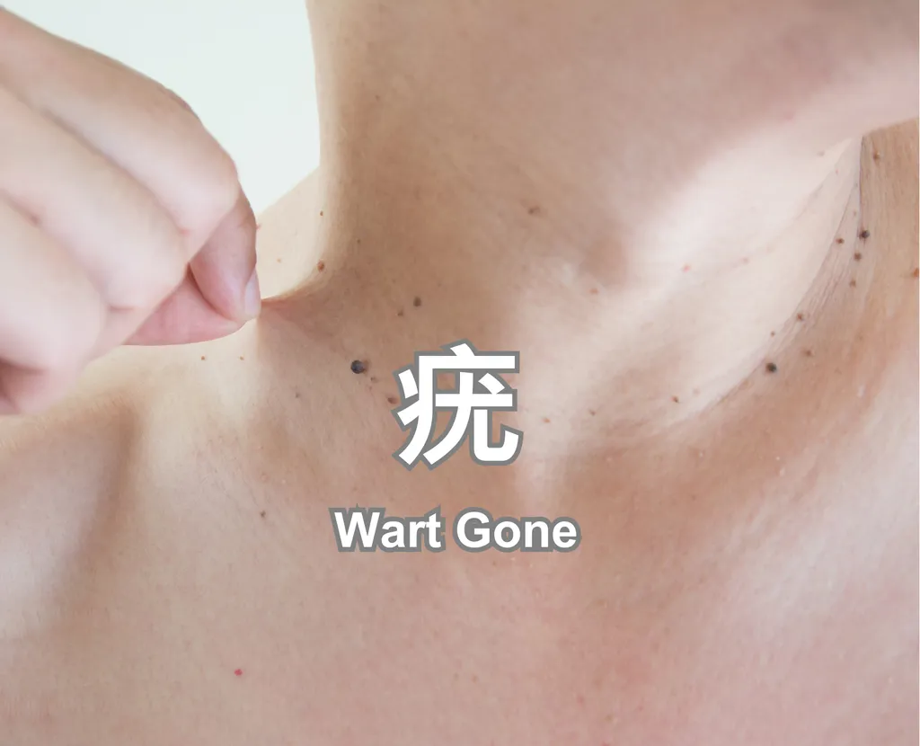 Wart Gone