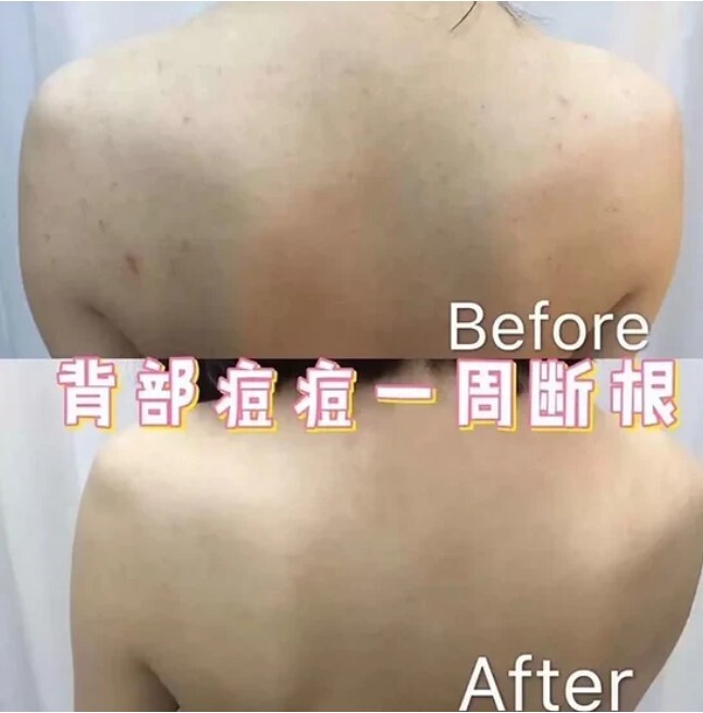 Pelican 祛痘美背皂 1