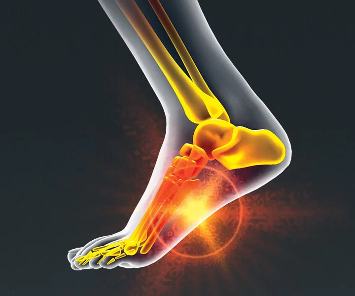 fix arch pain in foot