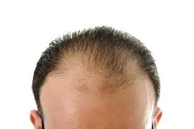 Rambut Botak Tengah – Punca & Cara Mengatasinya