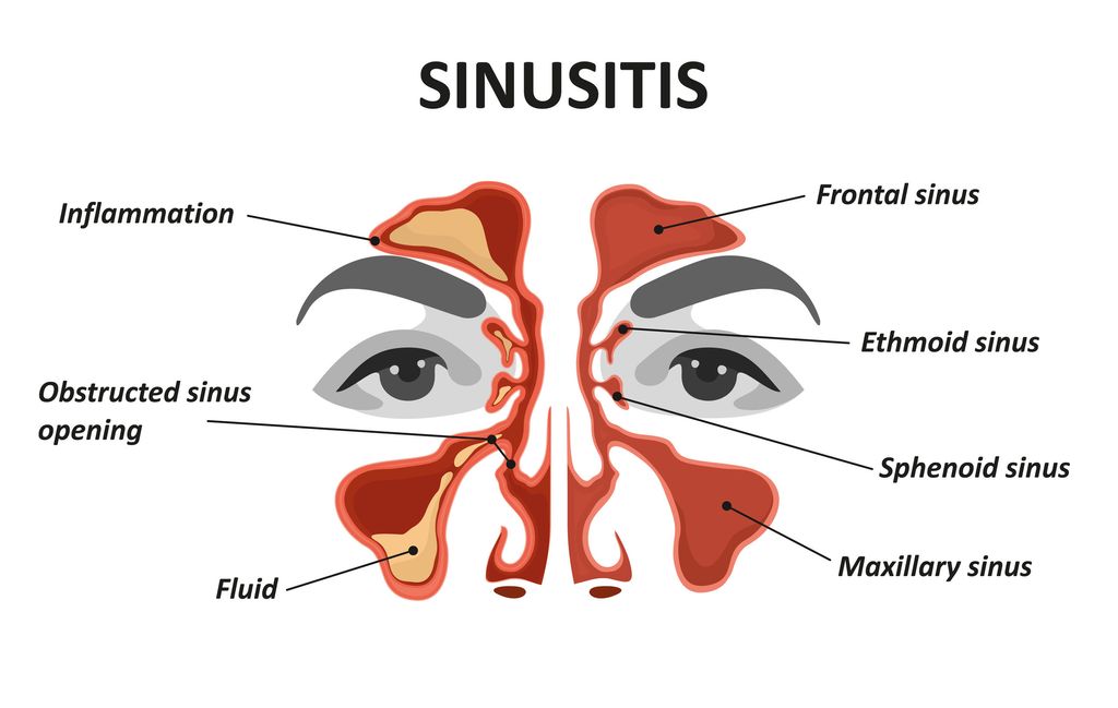 What is Sinusitis