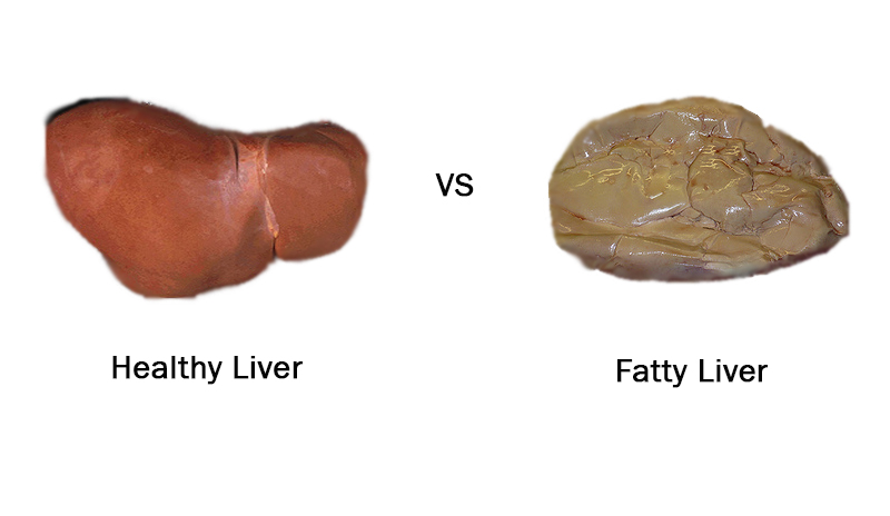 fatty liver vs.jpg