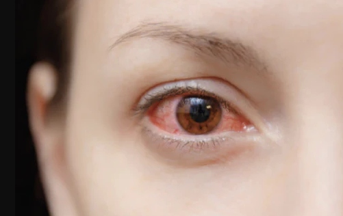 Red Eyes Contact lens Single Pieces is not Advisable