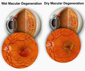 Age-Related Macular Degeneration (AMD) optometrist can help optical shop near me