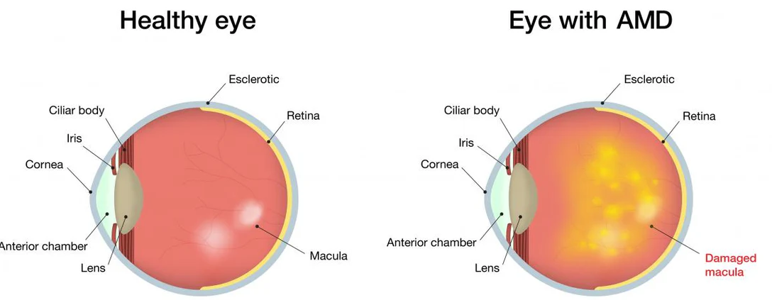 Age-Related Macular Degeneration (AMD)