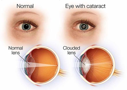 Cataract: Causes and Symptoms