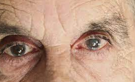 Cataract explain online contact lens shop sale best senior man