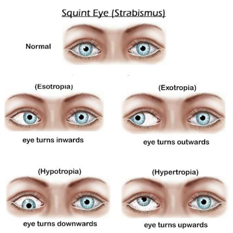 Strabismus (Crossed Eyes) boy optical shop online contact lens explained