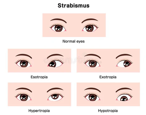 Amblyopia (Lazy Eye) optical shop online best contact lens sale types of strabismus