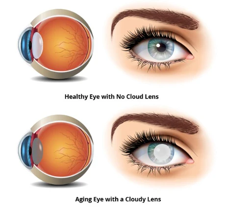 Amblyopia (Lazy Eye) optical shop online best contact lens sale eye conditions