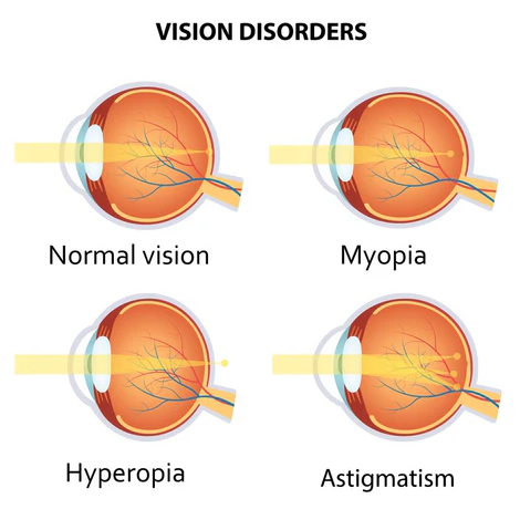 Amblyopia (Lazy Eye) optical shop online best contact lens sale vision disorders explain