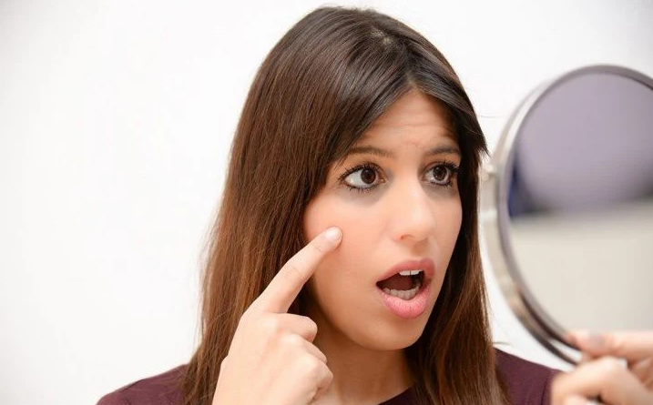 Dark Eye Circles