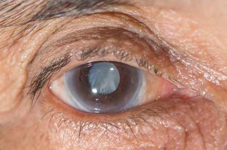 Glaucoma optical shop online selling buying contact lenses senior eyes best price
