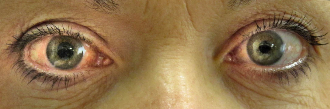 Glaucoma