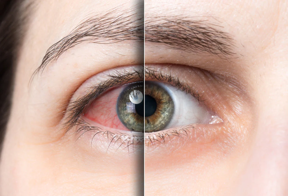 Best of Dry Eye Contact Lenses