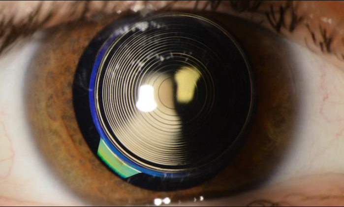 Things to know about Multifocal Lenses