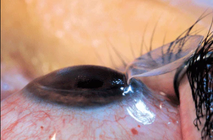 Can LASIK fix Astigmatism?