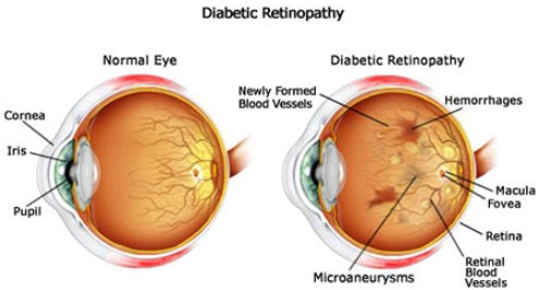 Diabetic retinopathy
