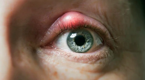 Type of Eye Infection best optical shop near me top online contact lens malaysia stye