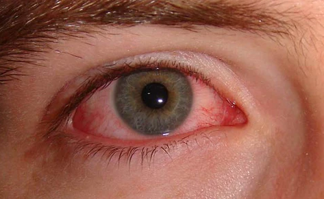 Type of Eye Infection best optical shop near me top online contact lens malaysia red eyes
